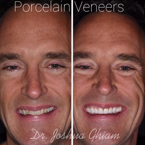 veneers-before-after