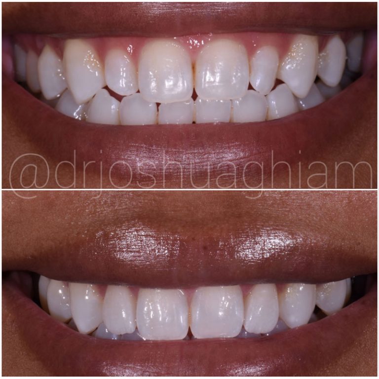 Porcelain Veneers Specialist Los Angeles Cosmetic Dentist