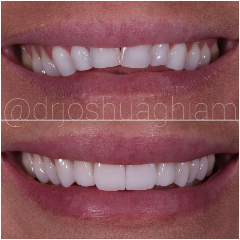 Porcelain Veneers Specialist Los Angeles Cosmetic Dentist