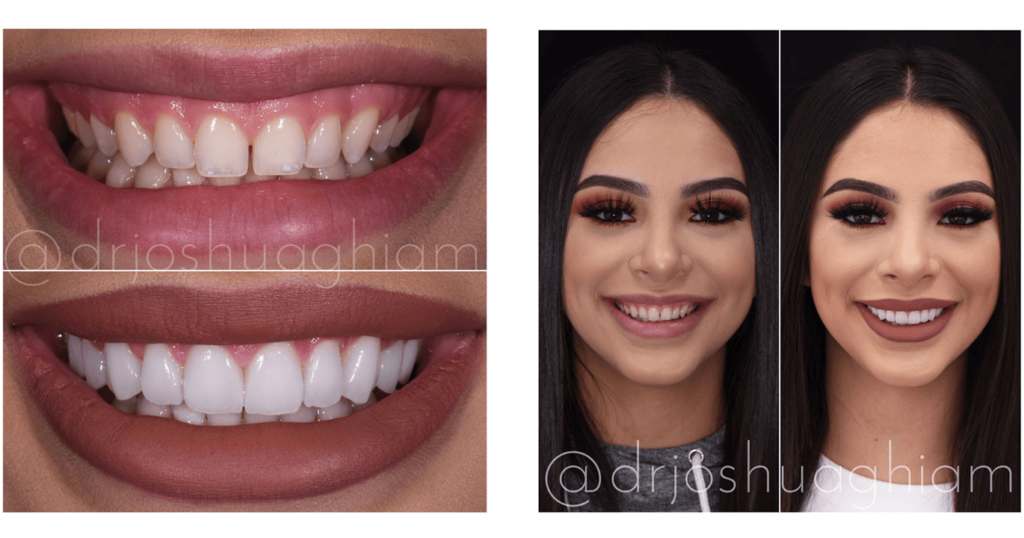 Good Veneers Vs Bad Veneers